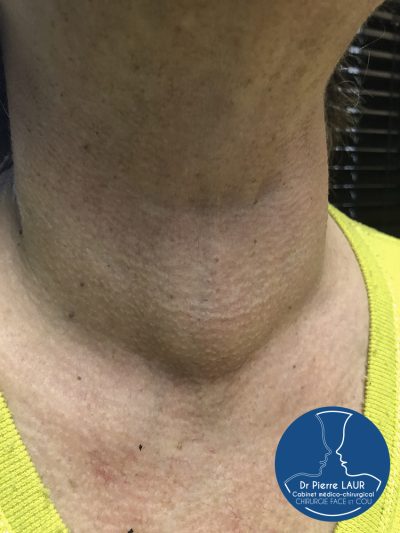 Chirurgie de la Thyroïde 1