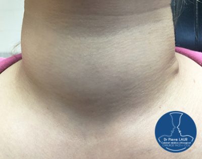 Chirurgie de la Thyroïde 2